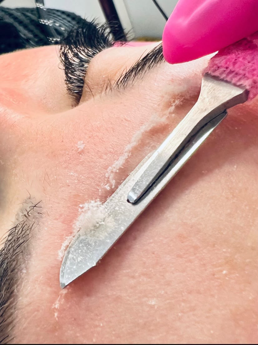 Dermaplaning
